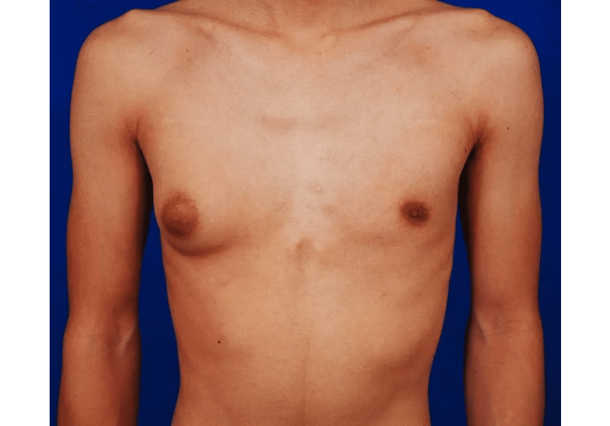 Почему у мужчин всё чаще начинает расти грудь - Врач назвала основные причины